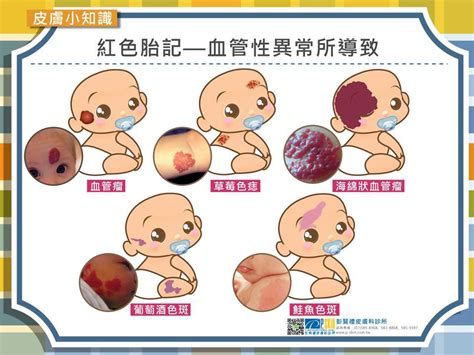 胎記 痣|認識胎記的種類與治療照顧